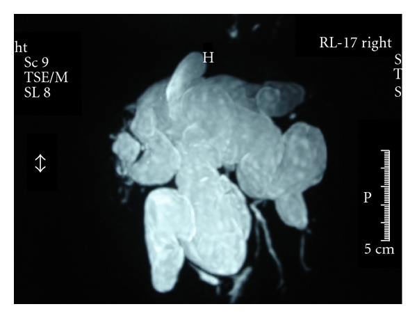 Living Donor Liver Transplantation for Caroli's Disease: A Report of Two Cases.