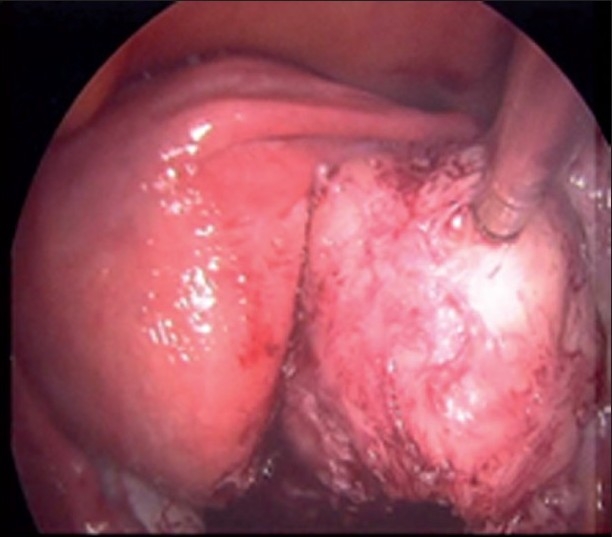 Single incision laparoscopic myomectomy.