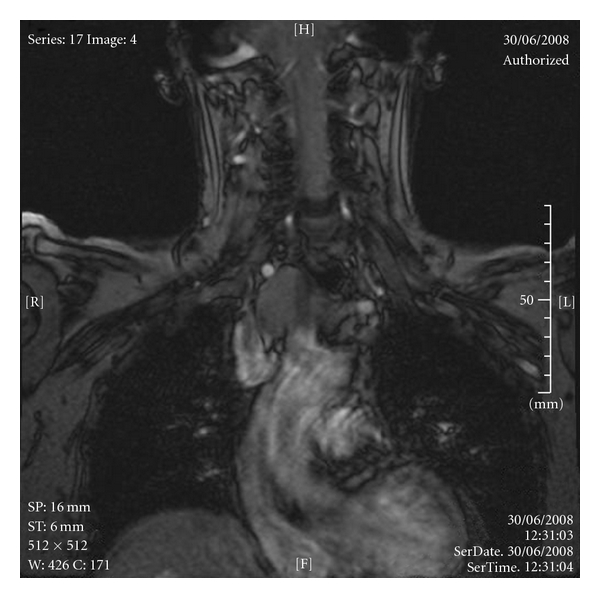 Ectopic sequestered thyroid tissue: an unusual cause of a mediastinal mass.