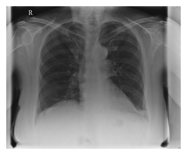 Ectopic sequestered thyroid tissue: an unusual cause of a mediastinal mass.