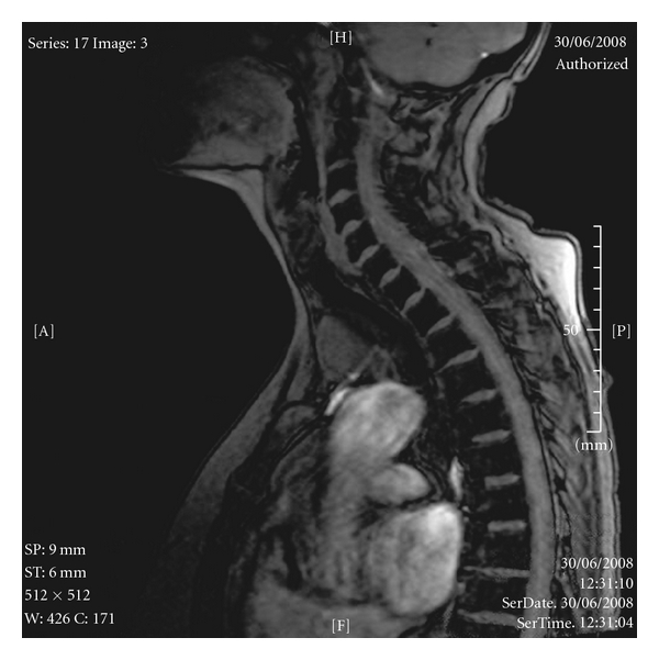 Ectopic sequestered thyroid tissue: an unusual cause of a mediastinal mass.