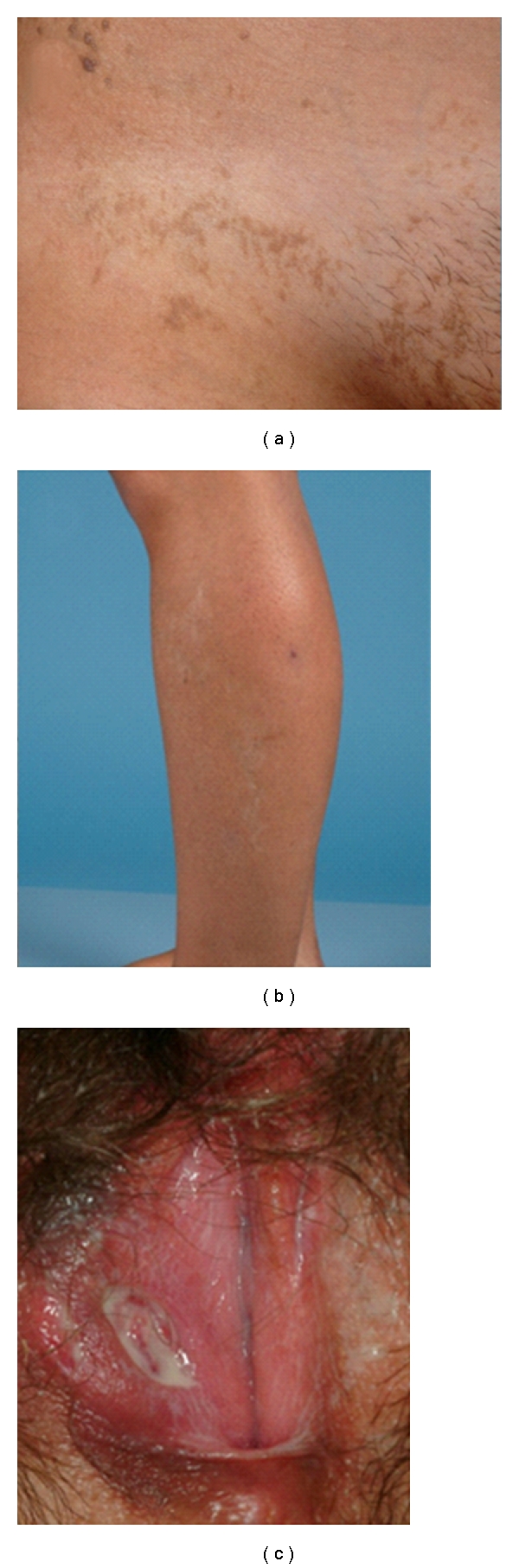 Incontinentia pigmenti and bipolar aphthosis: an unusual combination.