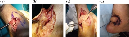 Distal posterior tibial artery perforator flaps for the management of calcaneal and Achilles tendon injuries in diabetic and non-diabetic patients.