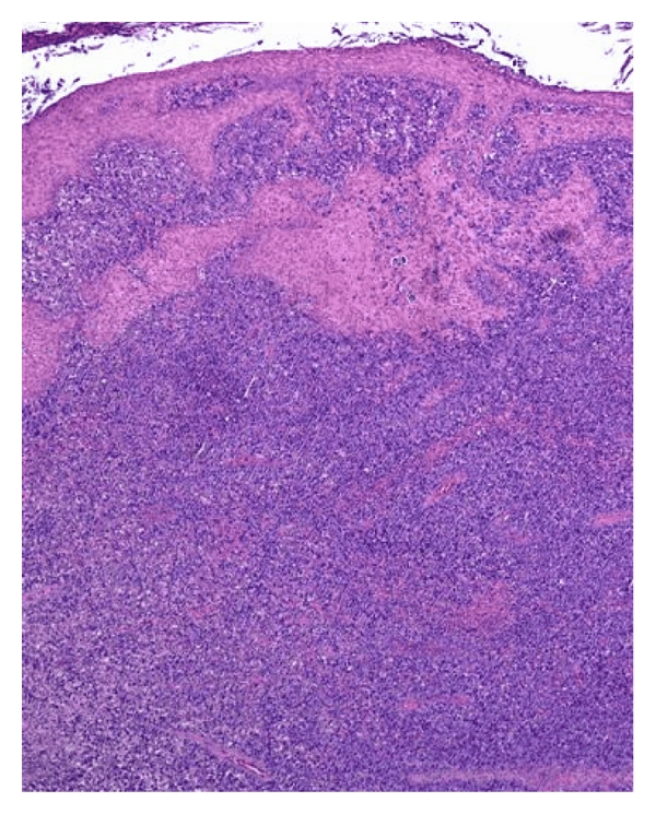 Primary Cutaneous CD30-Positive Large T-Cell Lymphoma in an 80-Year-Old Man: A Case Report.