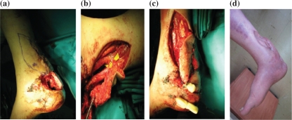 Distal posterior tibial artery perforator flaps for the management of calcaneal and Achilles tendon injuries in diabetic and non-diabetic patients.