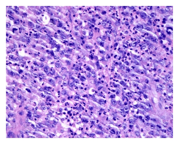 Primary Cutaneous CD30-Positive Large T-Cell Lymphoma in an 80-Year-Old Man: A Case Report.