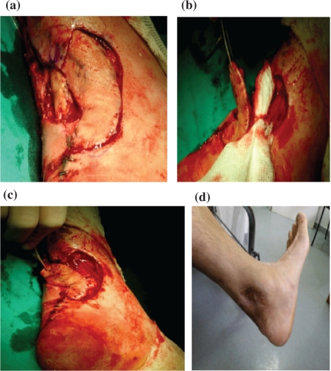 Distal posterior tibial artery perforator flaps for the management of calcaneal and Achilles tendon injuries in diabetic and non-diabetic patients.