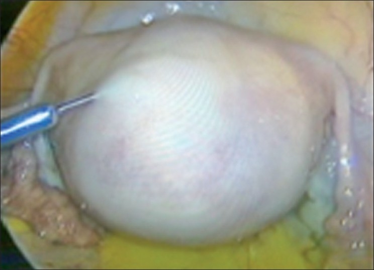 Laparoscopic myomectomy: methods to control bleeding.