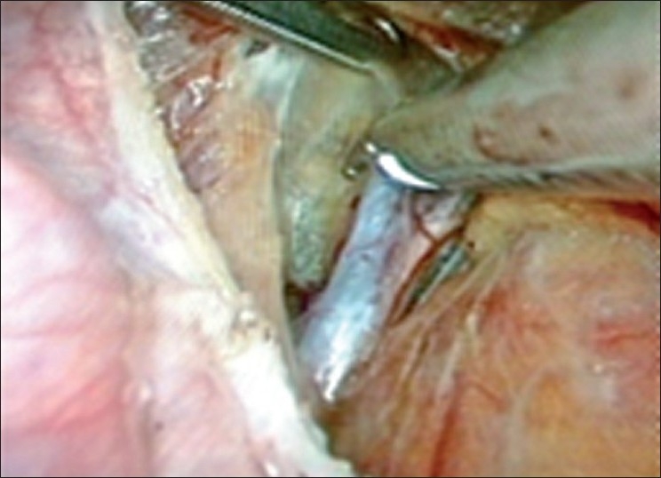 Laparoscopic myomectomy: methods to control bleeding.