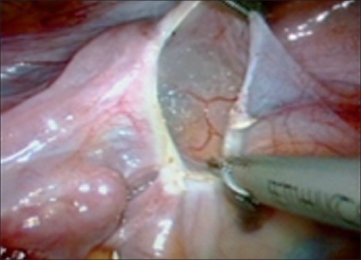 Laparoscopic myomectomy: methods to control bleeding.