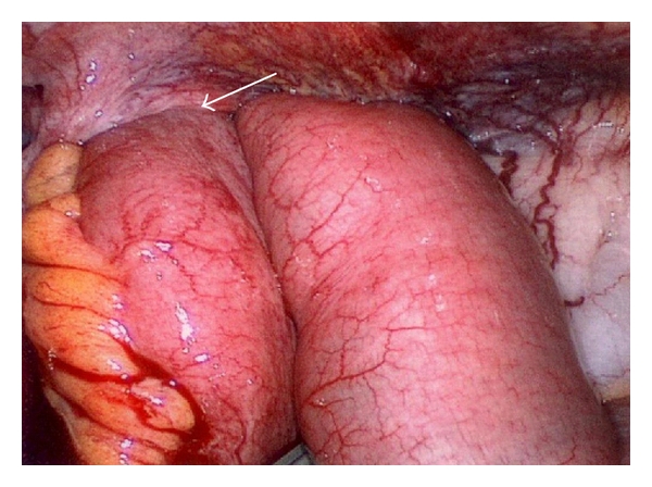 Small bowel obstruction caused by an incarcerated hernia after iliac crest bone harvest.