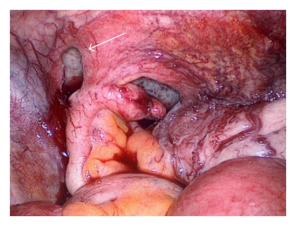 Small bowel obstruction caused by an incarcerated hernia after iliac crest bone harvest.