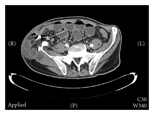 Small bowel obstruction caused by an incarcerated hernia after iliac crest bone harvest.