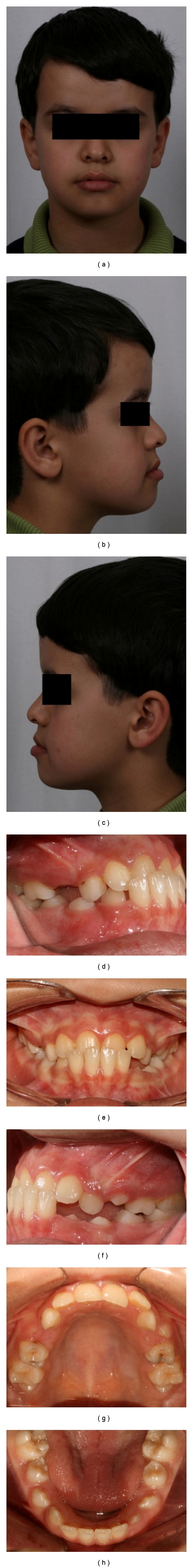 Treatment of maxillary deficiency by miniplates: a case report.