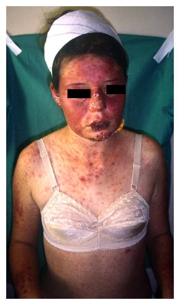 A girl with cutaneous lesions, polyarthritis, and antinuclear antibodies positivity.