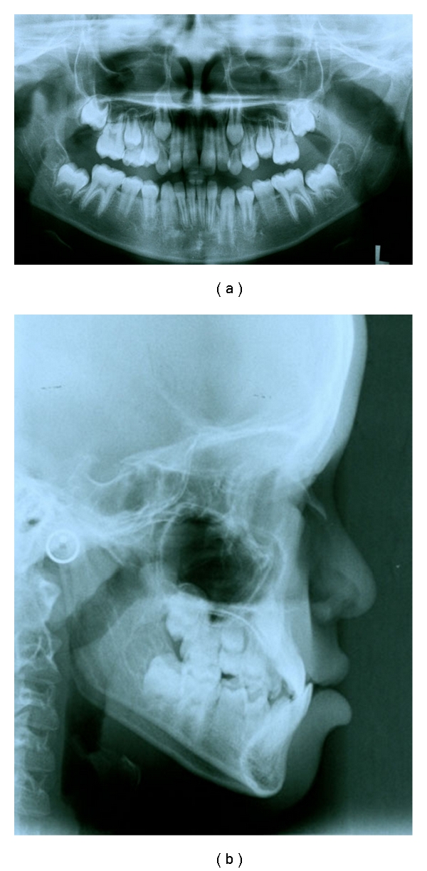 Treatment of maxillary deficiency by miniplates: a case report.