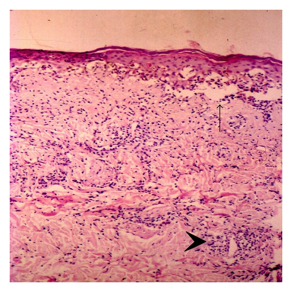 A girl with cutaneous lesions, polyarthritis, and antinuclear antibodies positivity.