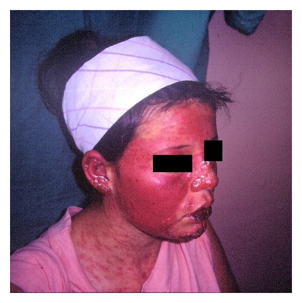 A girl with cutaneous lesions, polyarthritis, and antinuclear antibodies positivity.