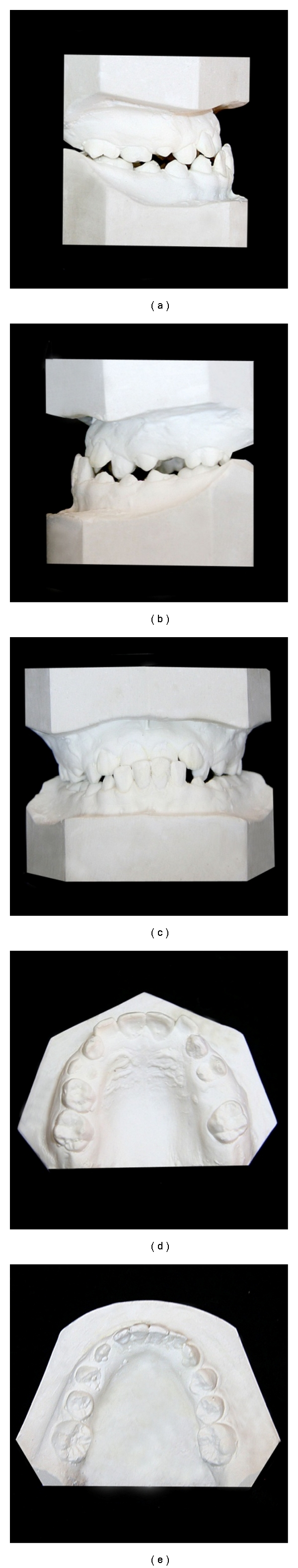 Treatment of maxillary deficiency by miniplates: a case report.