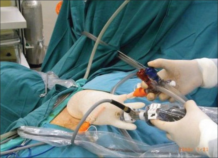 Single-port access laparoscopic hysterectomy: a new dimension of minimally invasive surgery.