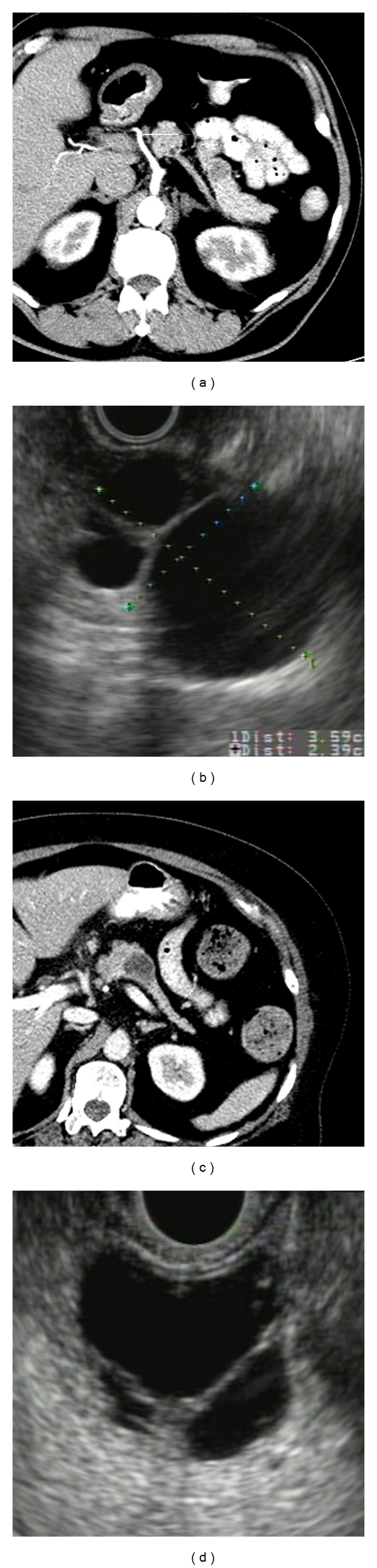 The use of protein-based biomarkers for the diagnosis of cystic tumors of the pancreas.