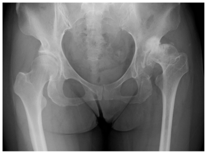 Effect of kampo medicine on pain and range of motion of osteoarthritis of the hip accompanied by acetabular dysplasia: case report and literature review.