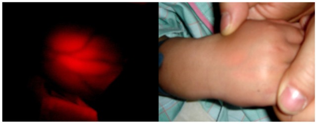 Effects of a transmitted light device for pediatric peripheral venipuncture and intravenous cannulation.