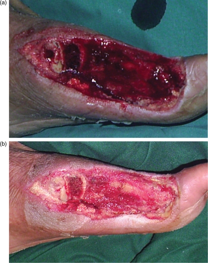 Effectiveness of bridge V.A.C. dressings in the treatment of diabetic foot ulcers.