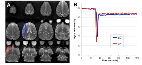 Dynamic Diffusion Magnetic Resonance Imaging of Infarct Formation and Peri-infarct Spreading Depression after Middle Cerebral Artery Occlusion (MCAO) in macacca fasicularis.