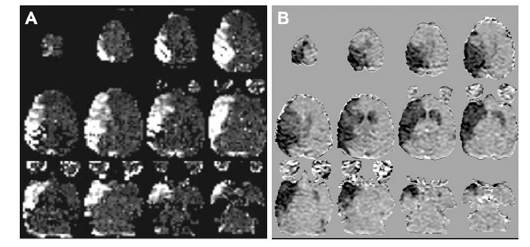 Dynamic Diffusion Magnetic Resonance Imaging of Infarct Formation and Peri-infarct Spreading Depression after Middle Cerebral Artery Occlusion (MCAO) in macacca fasicularis.