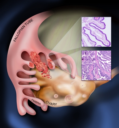 The new face of ovarian cancer modeling: better prospects for detection and treatment.