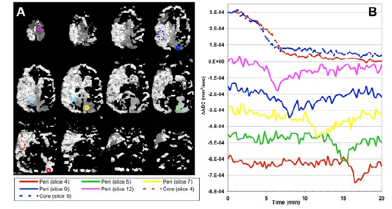 Dynamic Diffusion Magnetic Resonance Imaging of Infarct Formation and Peri-infarct Spreading Depression after Middle Cerebral Artery Occlusion (MCAO) in macacca fasicularis.