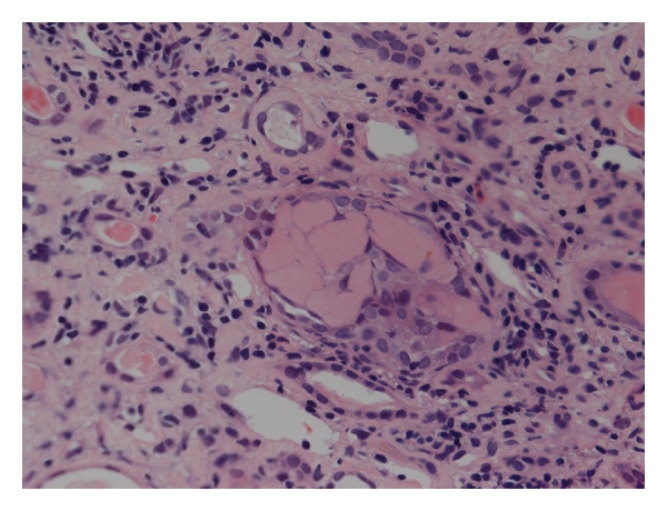 Recent advances in the pathogenesis and management of cast nephropathy (myeloma kidney).