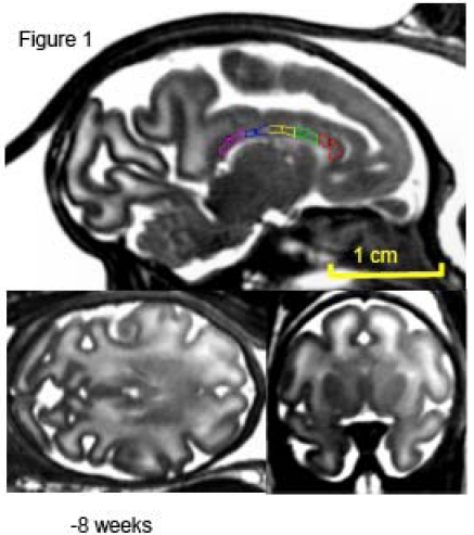 Tracking development of the corpus callosum in fetal and early postnatal baboons using magnetic resonance imaging.