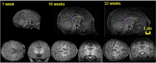 Tracking development of the corpus callosum in fetal and early postnatal baboons using magnetic resonance imaging.