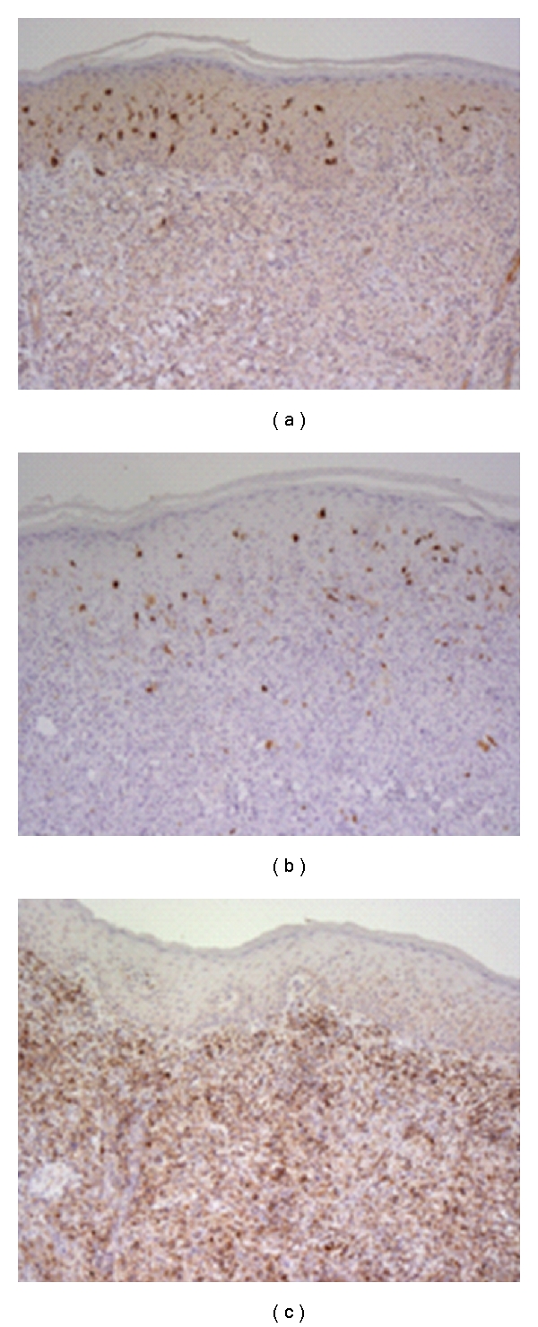 Xanthoma disseminatum in a pair of blind, deaf male twins.