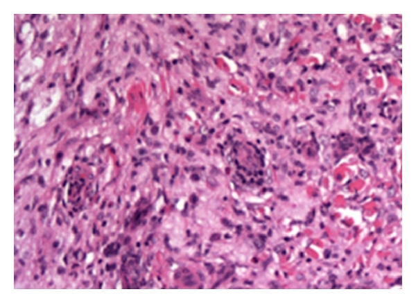 Xanthoma disseminatum in a pair of blind, deaf male twins.