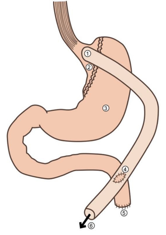 The surgical management of obesity with emphasis on the role of post operative imaging.