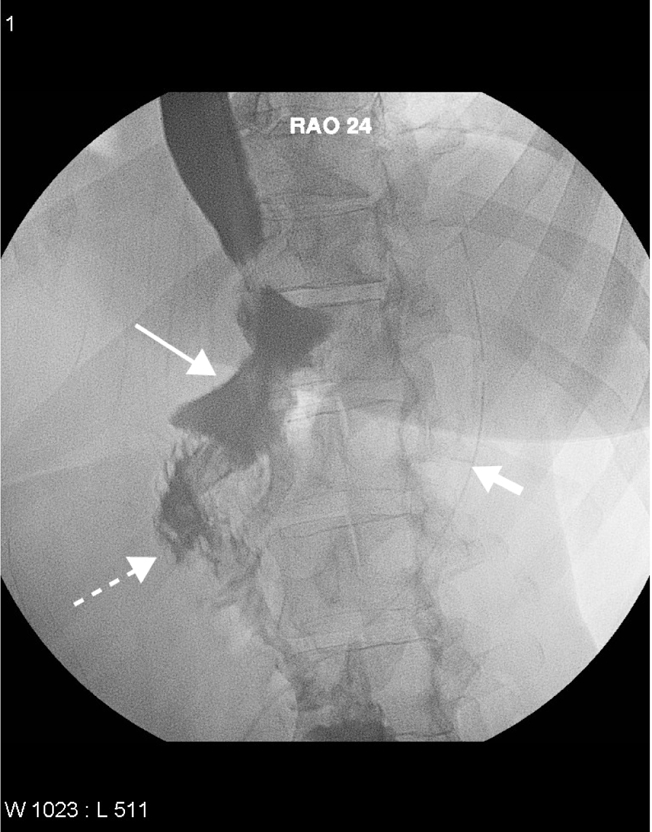 The surgical management of obesity with emphasis on the role of post operative imaging.