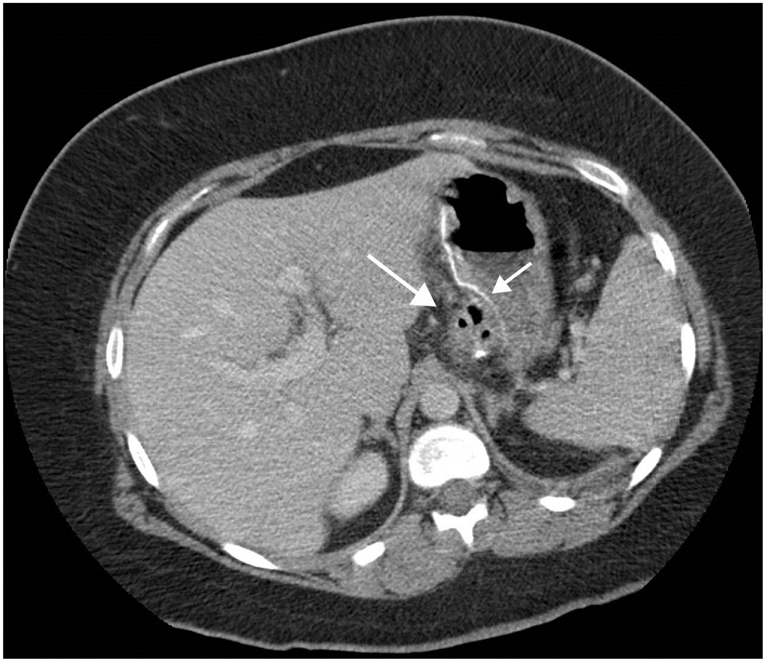 The surgical management of obesity with emphasis on the role of post operative imaging.
