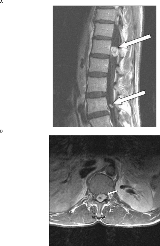 Polyradiculopathies from schwannomatosis.