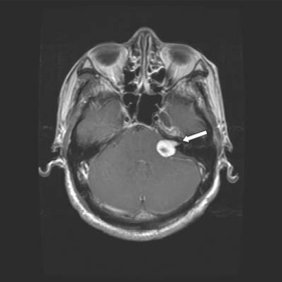 Polyradiculopathies from schwannomatosis.