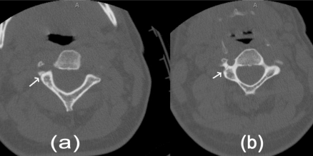 The role of neuroimaging in the latent period of blunt traumatic cerebrovascular injury.