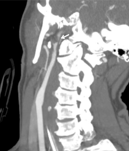 The role of neuroimaging in the latent period of blunt traumatic cerebrovascular injury.