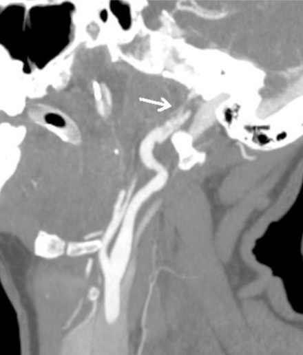 The role of neuroimaging in the latent period of blunt traumatic cerebrovascular injury.