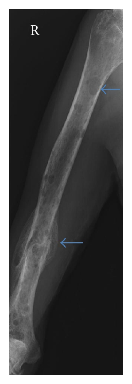 Multiple myeloma: a review of imaging features and radiological techniques.