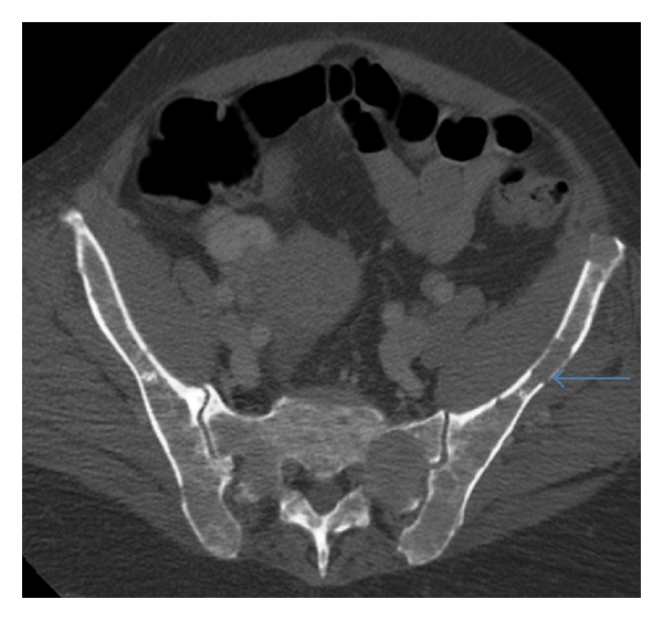 Multiple myeloma: a review of imaging features and radiological techniques.