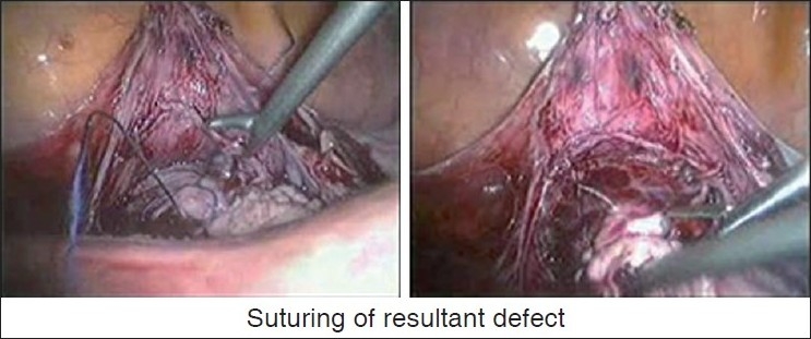 Handling cervical myomas.