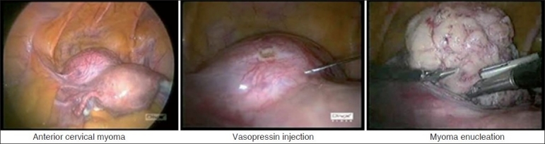 Handling cervical myomas.