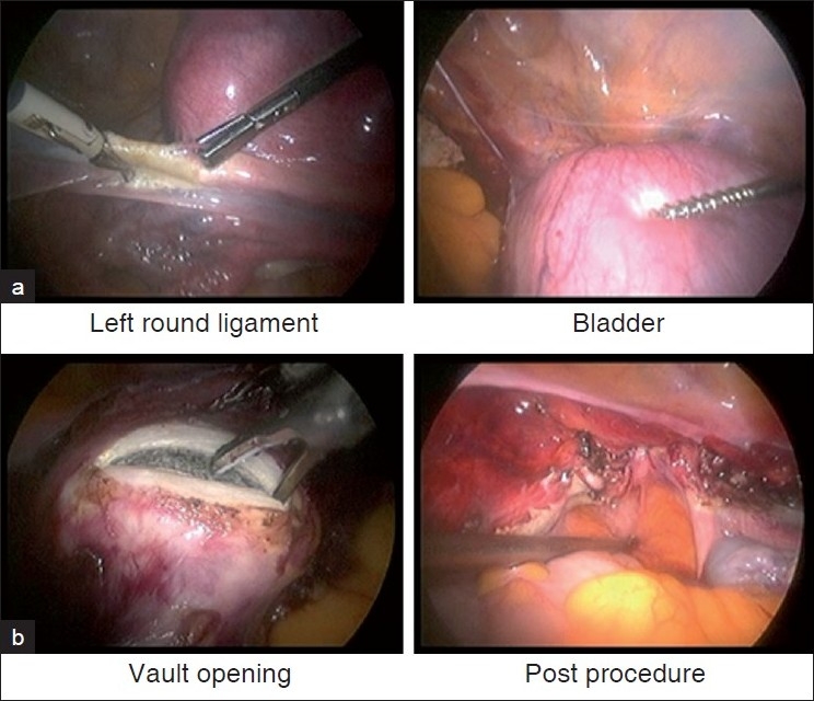 Handling cervical myomas.